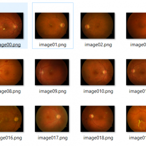 پروژه پیش بینی بیماری دیابت بر اساس تصاویر ضایعات چشم با استفاده از الگوریتم KNN در متلب (پردازش تصویر)