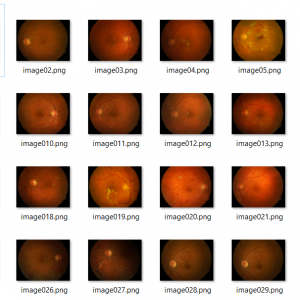 پروژه تشخیص بیماری دیابت بر اساس تصاویر ضایعات چشم با استفاده از روش های بوستینگ (Boosting) در متلب